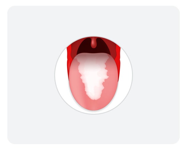 An illustration of a tongue with a creamy-white coating, a tell-tale indicator of oral thrush.