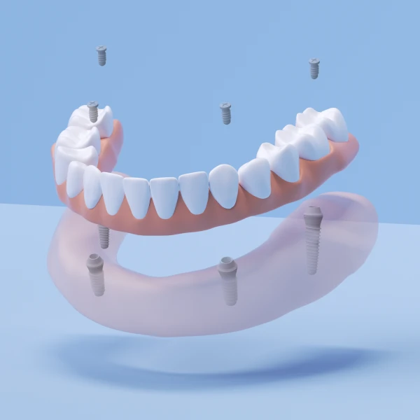 A 3D image of Aspen Dental fixed full arch implants. 