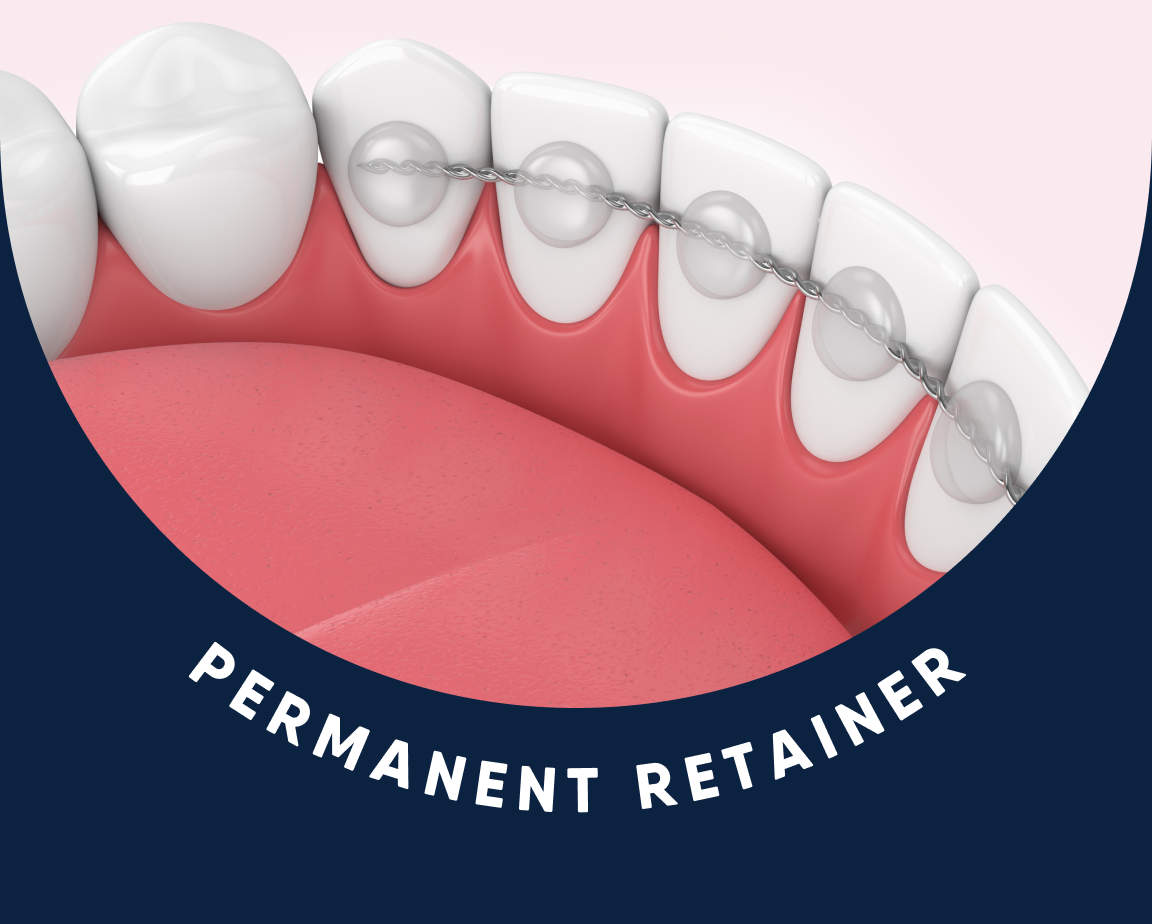 Illustration showing a close-up of a lower jaw with teeth where a permanent retainer is fixed to the inner surface, with the words "PERMANENT RETAINER" at the bottom