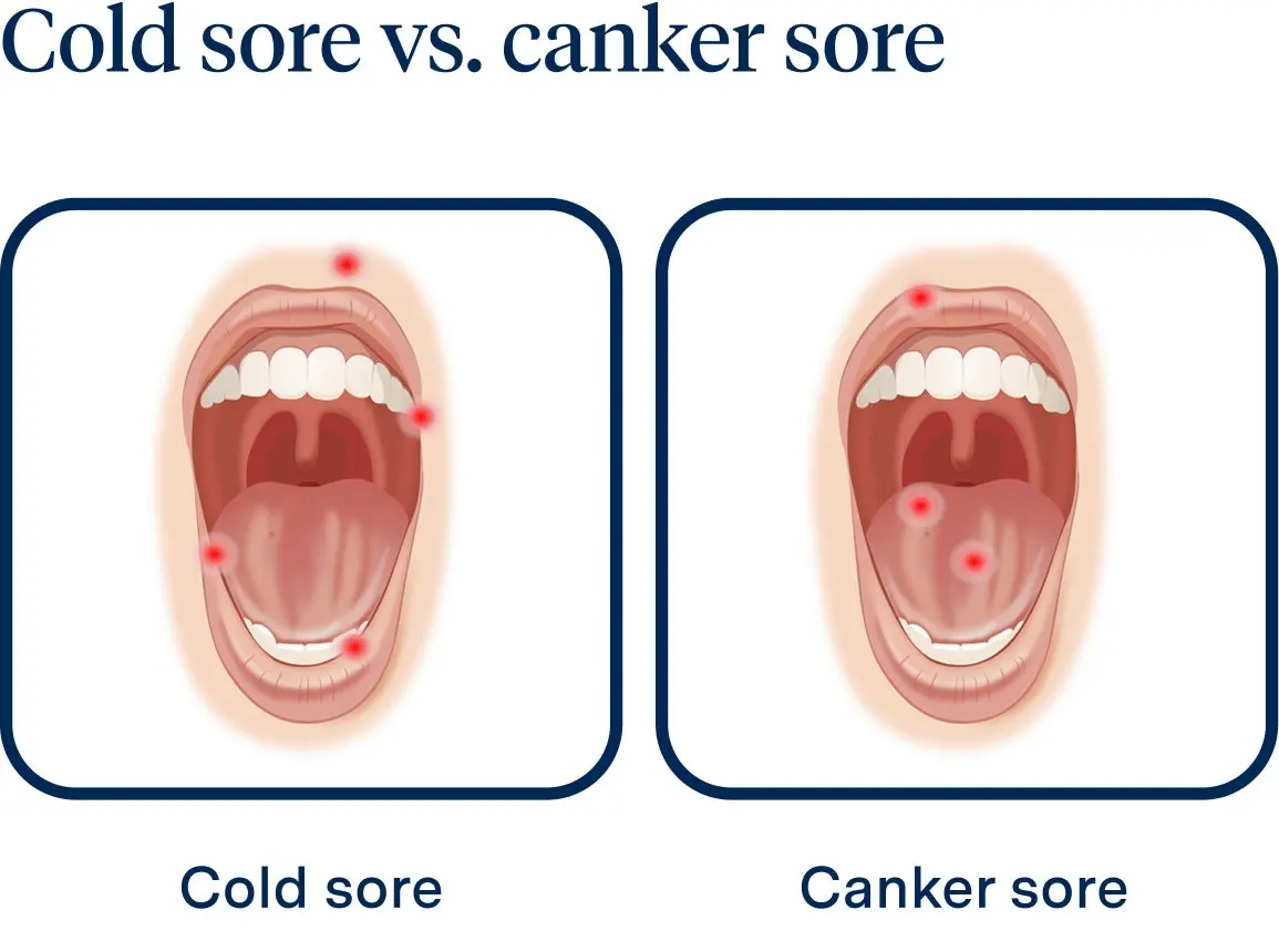Infographic comparing cold sores and canker sores, showing illustrations of mouth locations with labels: “cold sore” on lip exterior and “canker sore” inside cheek. Helps explain visual and positional differences for patients.