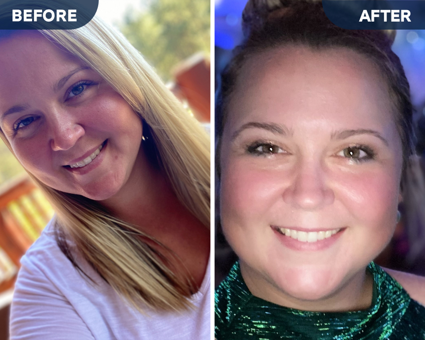 Before and After Motto Clear Aligners Reviews Aspen Dental