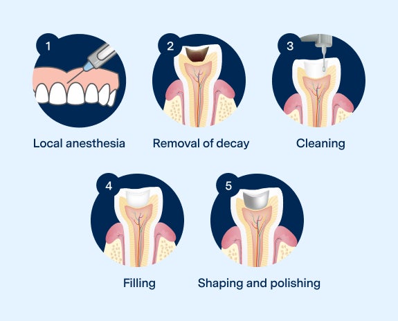 Illustration of the five steps in the dental filling process at Aspen Dental, including anesthesia, decay removal, cleaning, filling, and polishing.