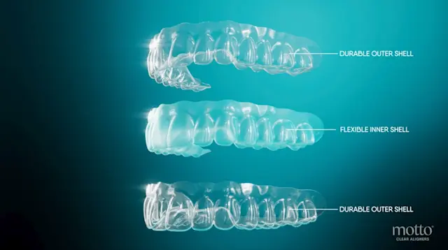 Transform Your Smile with Clear Aligners: Lasting Quality | Motto