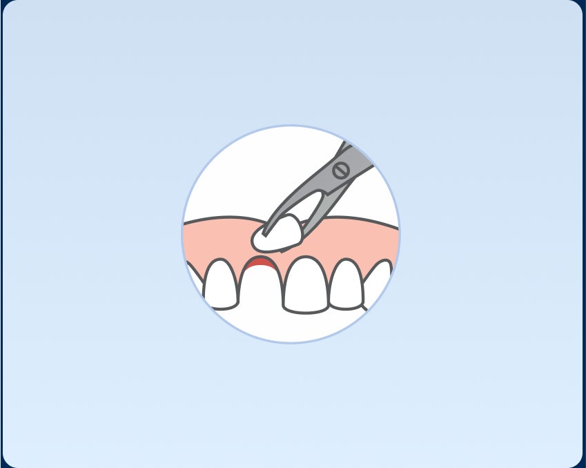Illustration of dental forceps removing a tooth from the upper gum during a tooth extraction, set within a circular frame against a light blue background.
