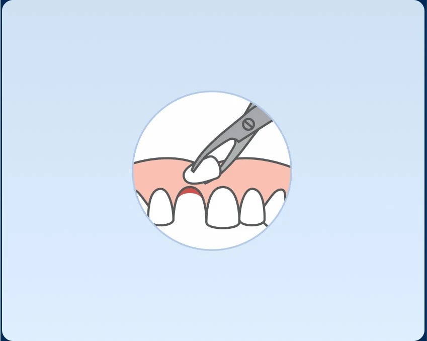 Illustration of dental forceps removing a tooth from the upper gum during a tooth extraction, set within a circular frame against a light blue background.