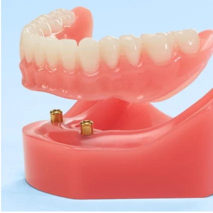Aspen Dental snap-in dentures, snap-in to their base. 