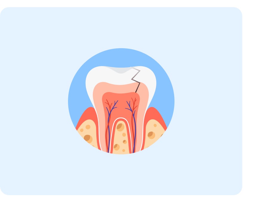 Illustration of a tooth that experienced trauma and injuries is embedded in gum tissue, displayed in a circular frame with a light blue background.