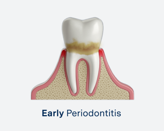 Illustration of a tooth affected by early periodontitis, showcasing gum inflammation and plaque buildup near the gumline.