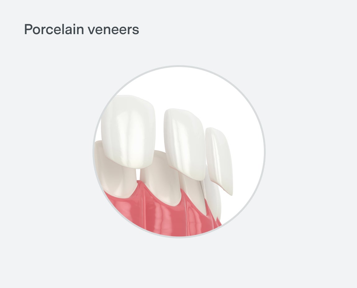 Illustration showing porcelain veneers being applied to teeth.