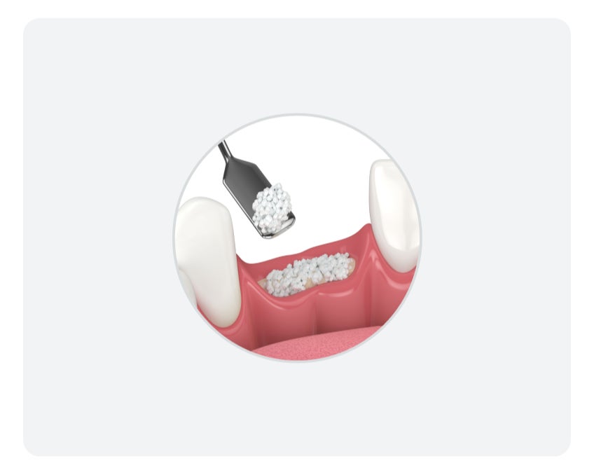 A lifelike graphic detailing the process of bone grafting in the jawbone, provind a solid foundation for the tooth implant.. 