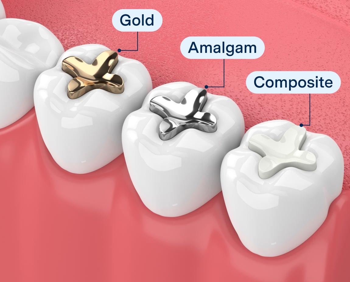 Illustration of four molars with different filling types: gold, amalgam, composite, and ceramic. This visual represents the materials used in various dental restoration images.