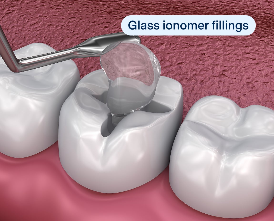 Dental tools apply a filling labeled "glass ionomer filling" to a molar. Highlights another type of image showing real-time cavity treatment steps.