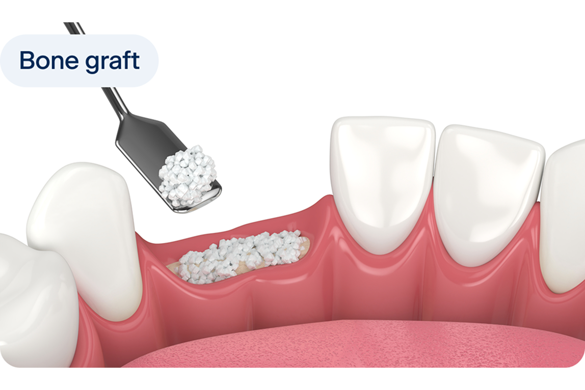 illustration of a dental bone graft procedure with bone material placed into the jaw to rebuild bone for future dental implant placement