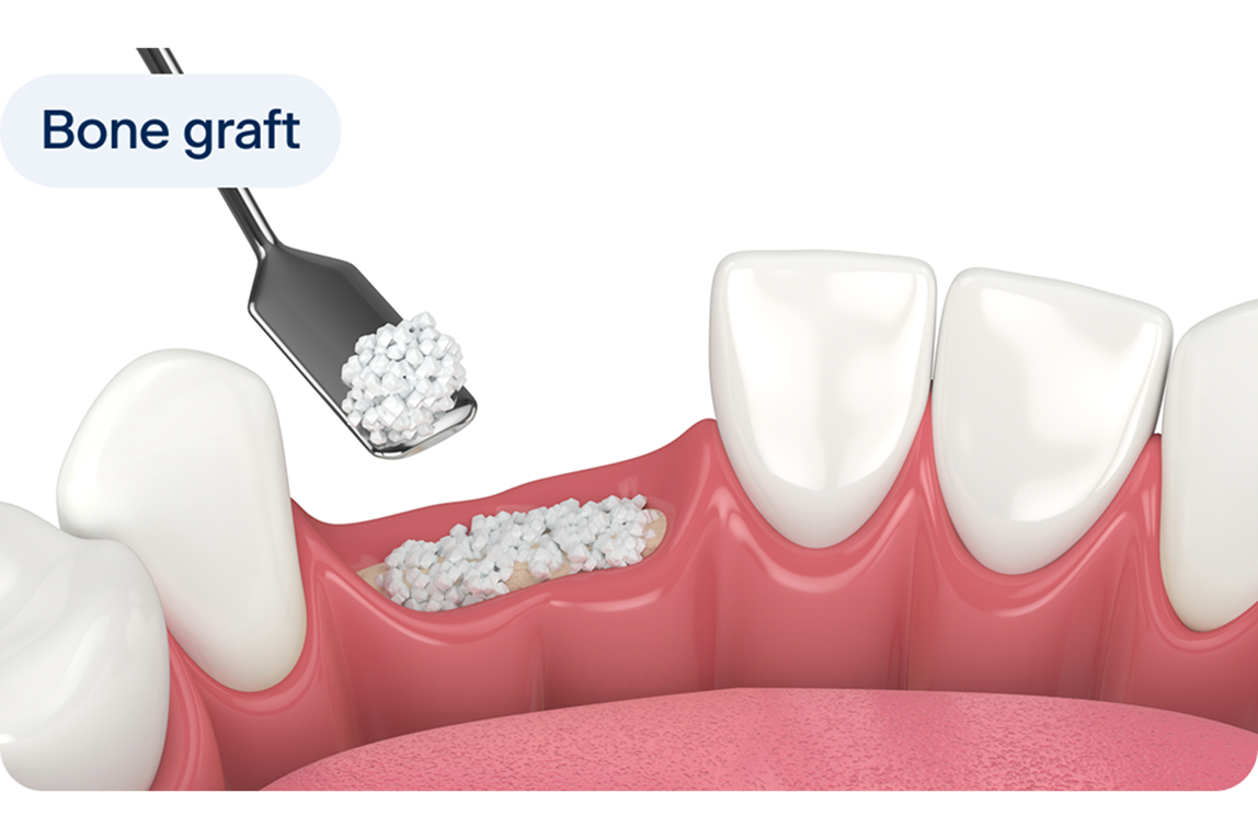 Bone graft for dental implants: what it is, why you may need one, and ...