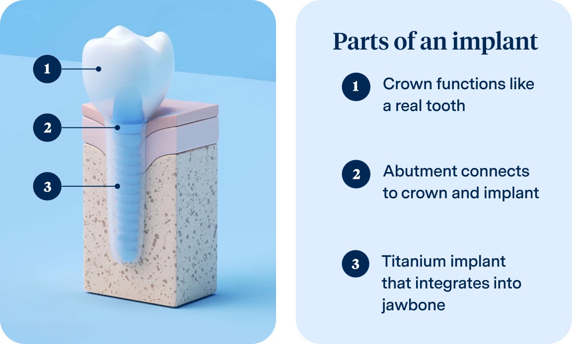 Infographic showing three parts of a dental implant: the crown that functions like a real tooth, the abutment connecting the crown and implant, and the titanium implant that integrates into the jawbone.