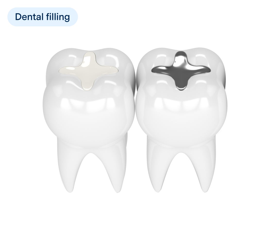 Illustration of two teeth showing different types of dental fillings, one with a white composite filling and the other with a silver amalgam filling, labeled with "Dental filling" in a dental treatment context.