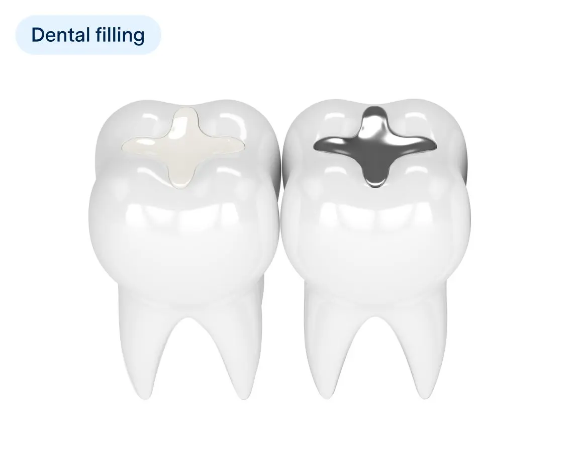 Illustration of two teeth showing different types of dental fillings, one with a white composite filling and the other with a silver amalgam filling, labeled with "Dental filling" in a dental treatment context.
