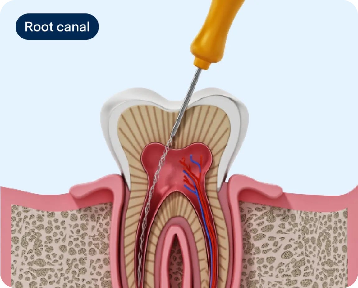 Medical illustration showing a tooth with root canal treatment. Highlights internal tooth structure and treatment area.