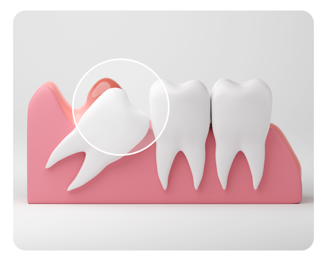 A 3D illustration shows an impacted wisdom tooth growing at an angle and pushing against a neighboring molar within a section of gums.