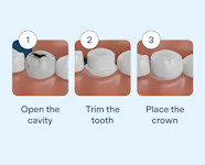 How Long Is A Dental Crown Procedure Detroit Chinatown