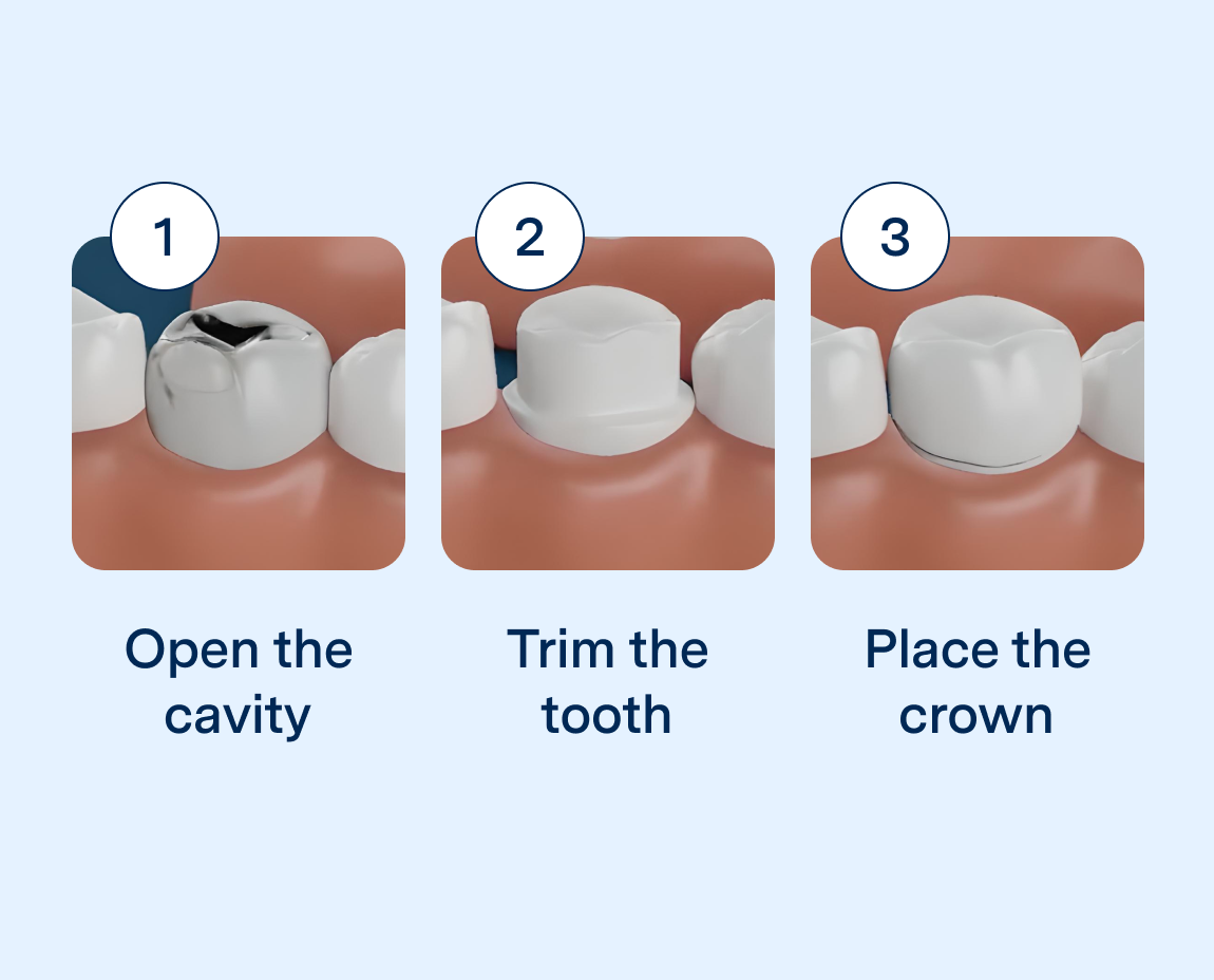 Step-by-step guide to place a dental crown in 3 easy steps:
treat the cavity and fill
trim the tooth enamel
place the dental crown