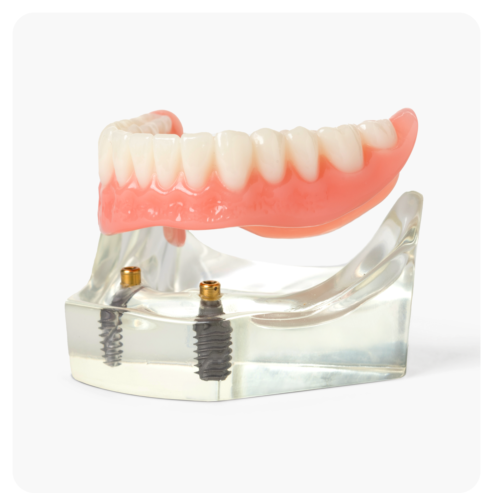 Aspen Dental lower jaw model displaying implant dentures with titanium posts for a stable, natural-feeling tooth replacement solution.