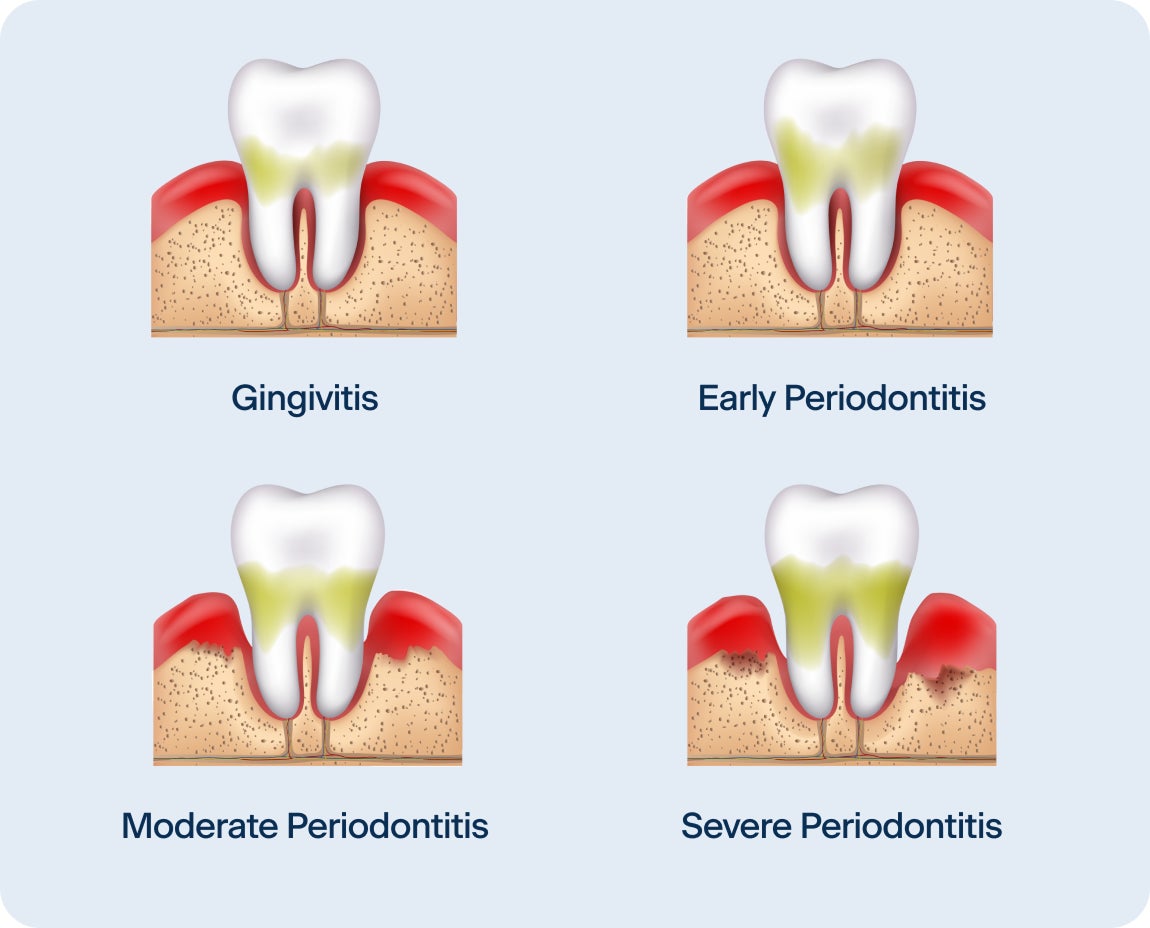 An image showing the four stages of periodontitis: gingivitis, early periodontitis, moderate periodontitis, and severe periodontitis, with the accumulation of plaque bacteria increasing for each stage, and bone loss gradually happening from moderate periodontitis to severe periodontitis.