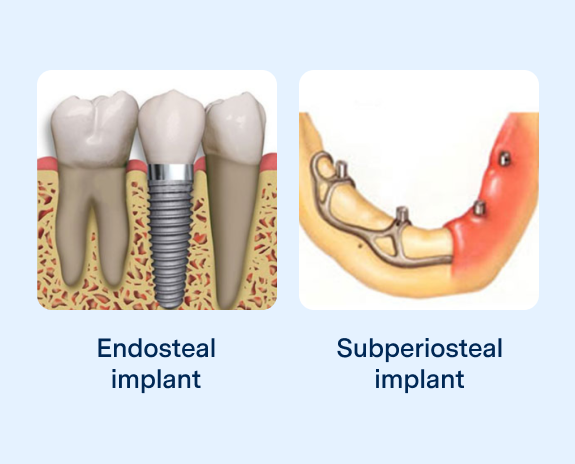 A side-by-side comparison of Endosteal and Subperiosteal dental implants, showcasing the different types of dental implant options available.