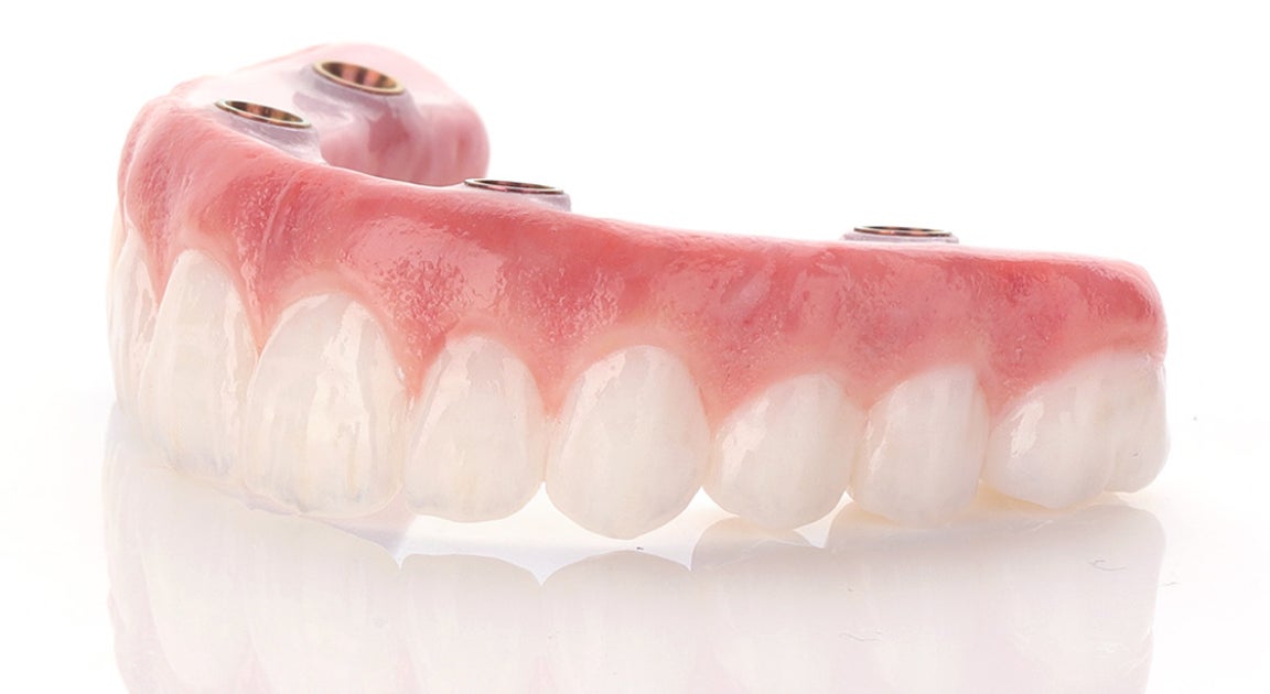 An upper arch dental implant model, which would range from $22,000 to $36,000 in cost, depending on factors such as additional procedures needed and material used.