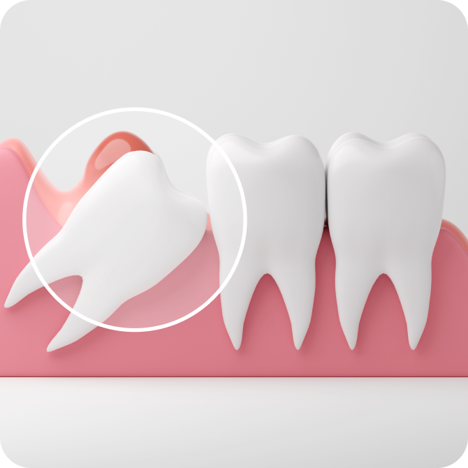 A 3D illustration shows an impacted wisdom tooth growing at an angle and pushing against a neighboring molar within a section of gums.