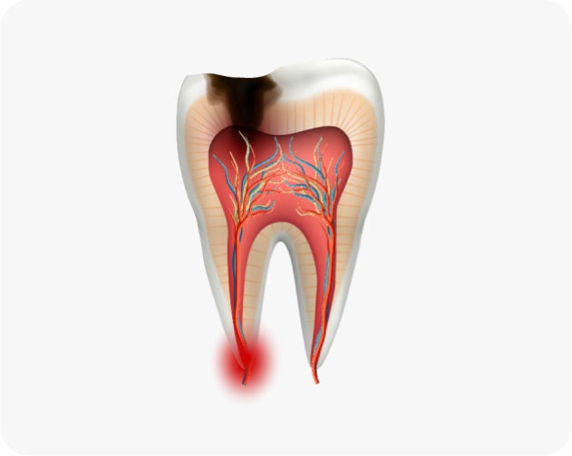 Diagram of a tooth with a cavity showing the internal structure, including nerves and blood vessels. The area around the root is highlighted in red, indicating dental abscess formation due to tooth decay.