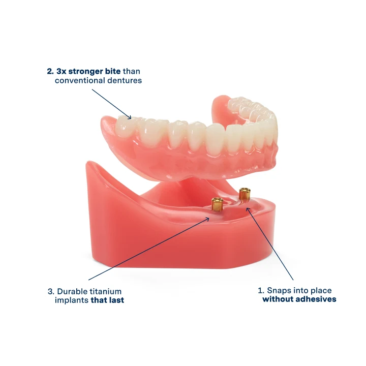 A model of a lower jaw implant dentures offered at Aspen Dental, highlighting its features like:
Snaps into place without adhesives
3 times stronger bite than conventional dentures
Durable titanium implants that last