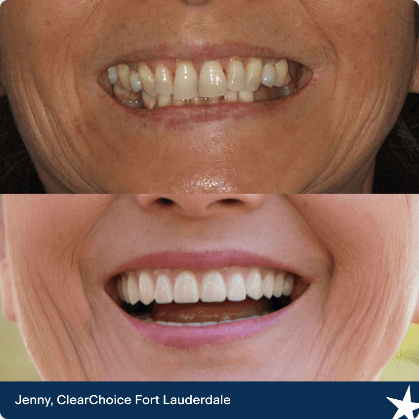 The before and after dental implant images of Jenny. Our ClearChoice patient from Fort Lauderdale.