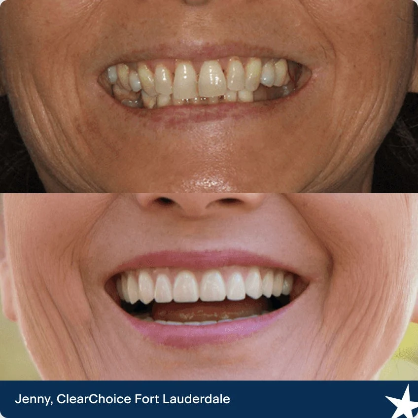 The before and after dental implant images of Jenny. Our ClearChoice patient from Fort Lauderdale.