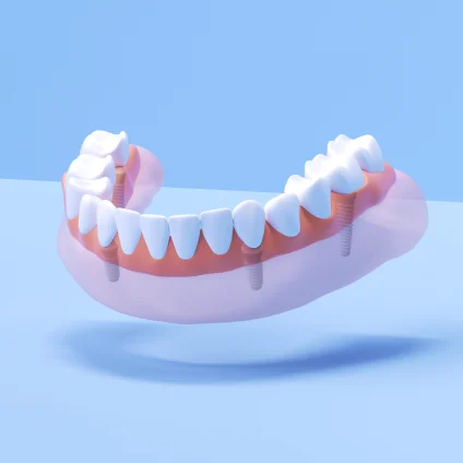 Aspen Dental full fixed arch implants. 