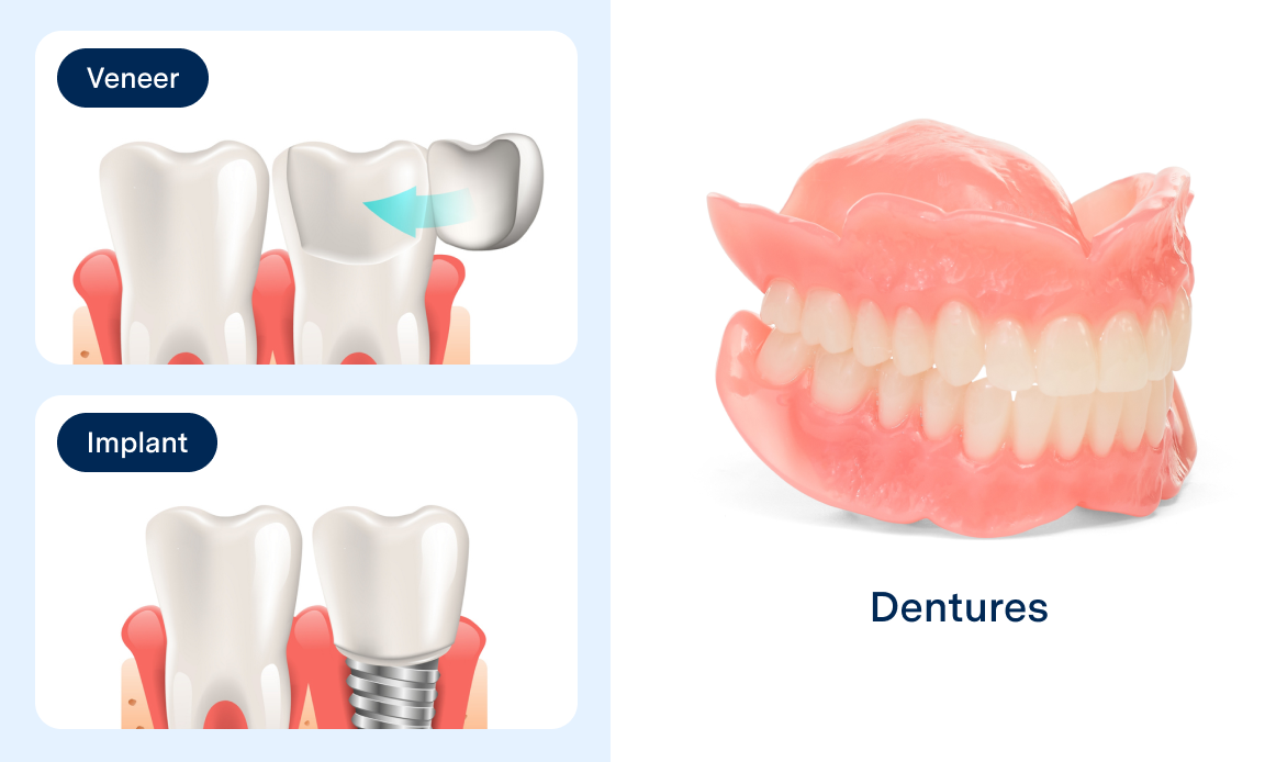 Graphic showcasing illustration of veneers, an implant, and a set of dentures, illustrating different dental solutions.