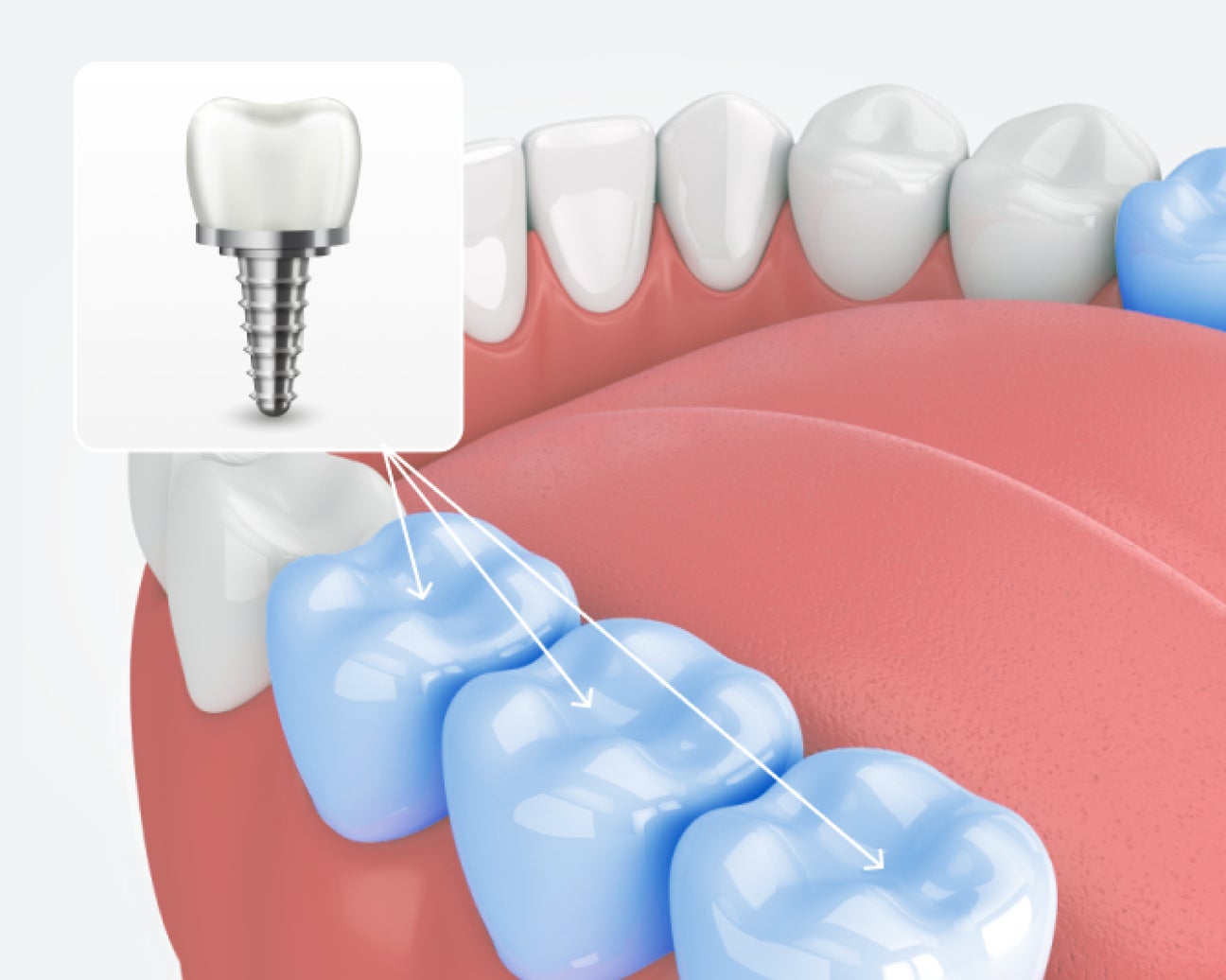 Illustration of a molar dental implant placed in the jaw, showing the implant screw and crown, featured on Aspen Dental's molar implants page.