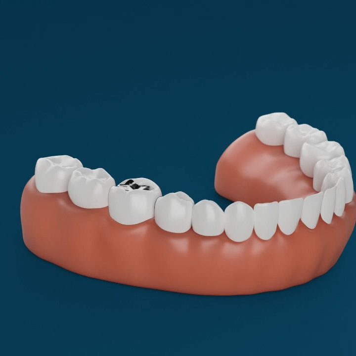 Aspen Dental crowns process image. 