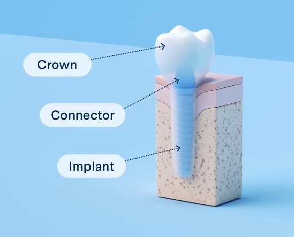 A 3D illustration of a dental implant showing the crown, connector, and implant components in a cross-sectional view.