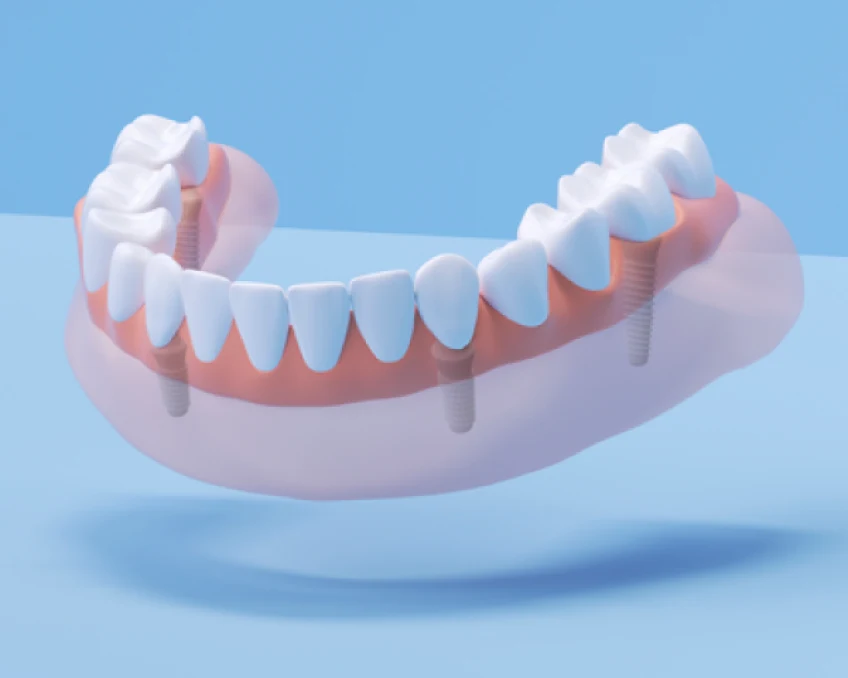 An illustration of a fixed full arch dental implants showcasing a fixed, full row of permanent teeth.