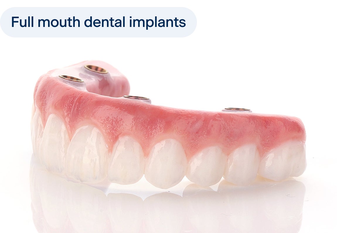 A full arch dental implant prosthesis with natural-looking teeth and gum design, used to restore an entire upper jaw.