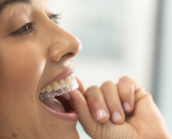 A woman putting on her invisible aligners to correct her overbite.