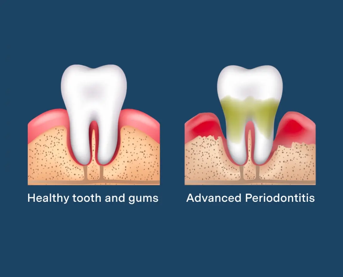 Illustration comparing a healthy tooth and gums with advanced periodontitis, highlighting gum health and periodontal disease progression.