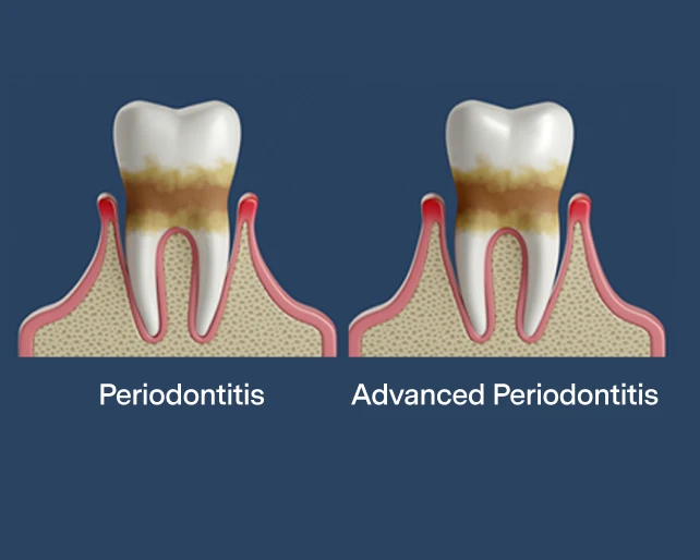 Periodontitis vs severe periodontitis