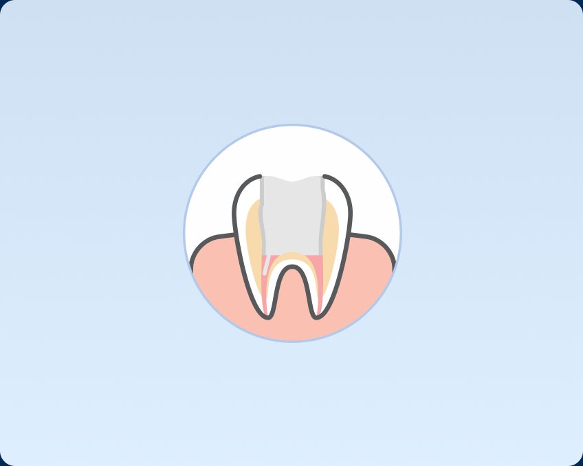 Illustration of a cross-section of a tooth showing enamel, dentin, hollow tooth, and gums on a light blue background.
