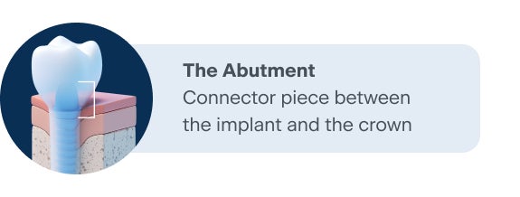 Illustration of a dental implant abutment, showing the connector piece between the implant and crown for ClearChoice.