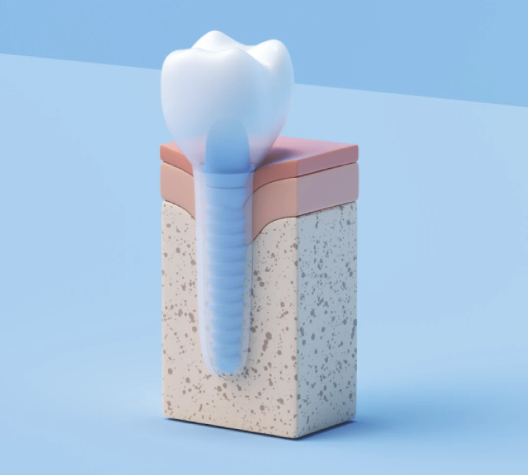 A 3D rendering of an Aspen Dental implant denture. 
