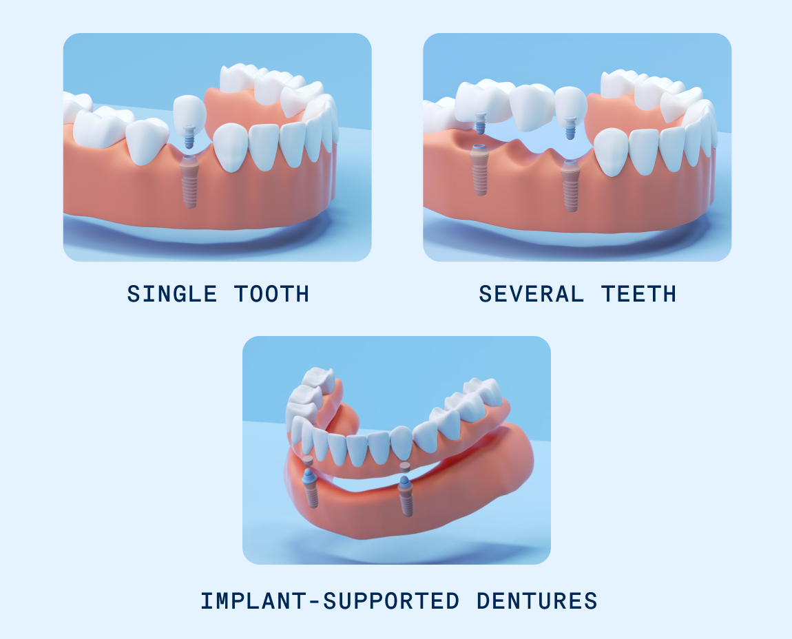 Three illustrations depicting different dental implants on a blue background: top-left shows a single tooth implant, top-right illustrates several teeth with implants, and the bottom image features a full lower arch of implant-supported dentures. Each implant type is labeled respectively.