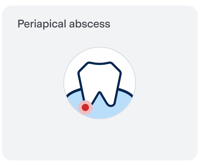 Illustration of a tooth with a red dot at the root, labeled "Periapical abscess," indicating a tooth abscess at the tip of the tooth's root.