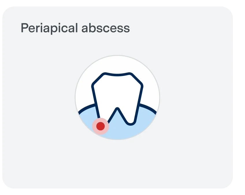Illustration of a tooth with a red dot at the root, labeled "Periapical abscess," indicating a tooth abscess at the tip of the tooth's root.